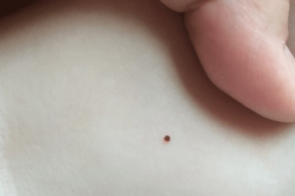 Baby Seed Ticks