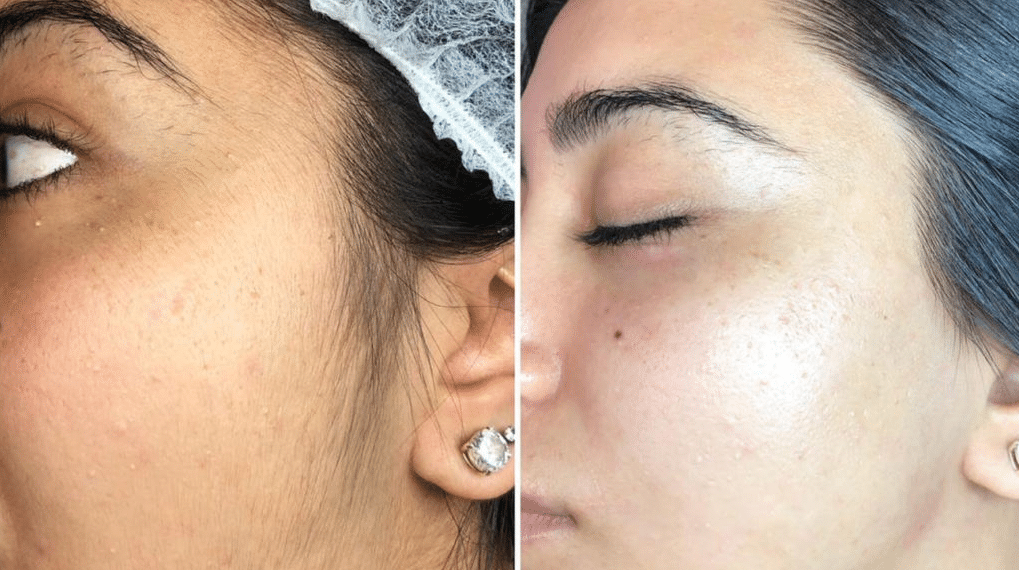 Dermaplaning With Oil And Benefits