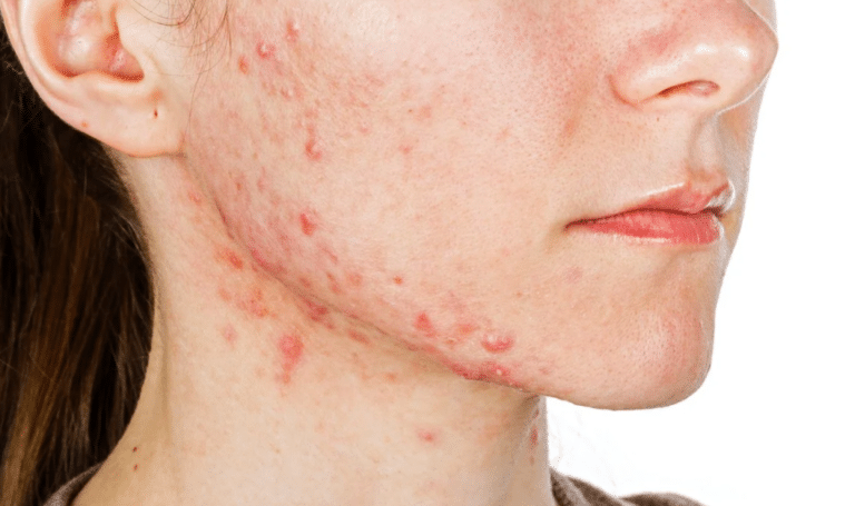 Fungal Acne Symptoms And Treatment