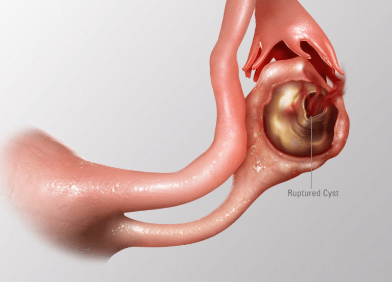 How Long Does Ruptured Ovarian Cyst Pain Last