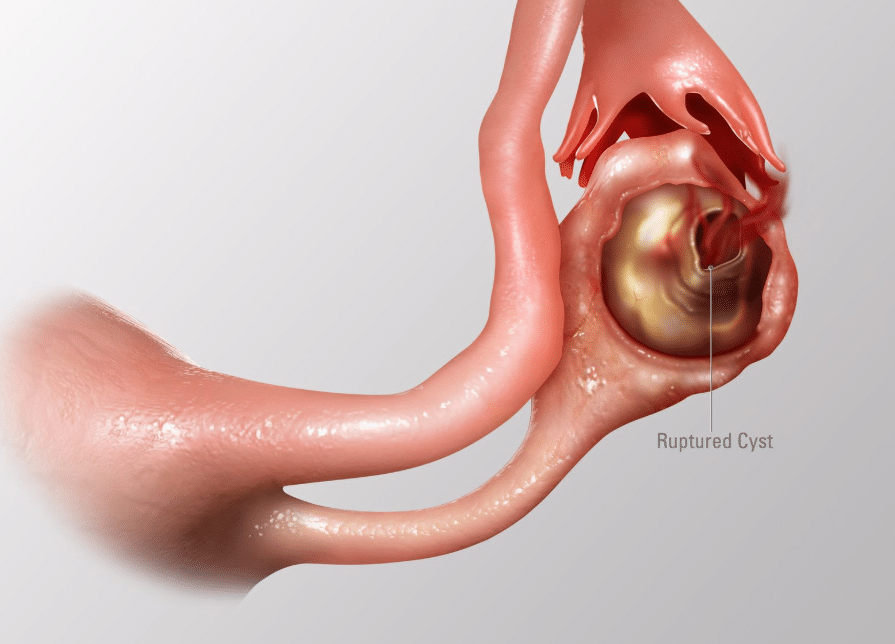 Late Period After Cyst Rupture